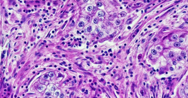 เมื่ออัลกอริทึมวินิจฉัยมะเร็งเริ่ม “เดาเชื้อชาติ” ของผู้ป่วย