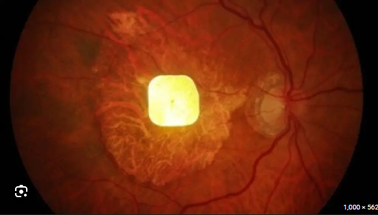 PRIMA ชิป AI ที่ช่วยให้ผู้ป่วยประสาทตาเสื่อมกลับมามองเห็น