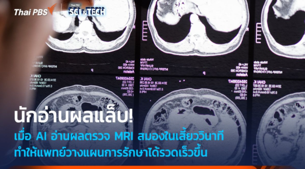 เมื่อ AI อ่านผลตรวจ MRI สมองในเสี้ยววินาที ช่วยวางแผนการรักษาได้เร็วขึ้น